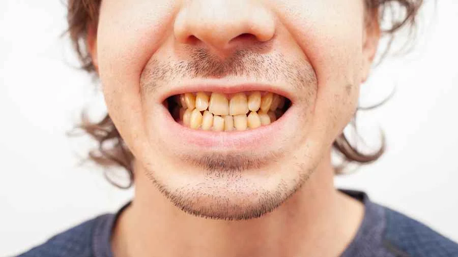 dientes amarillos_blog
