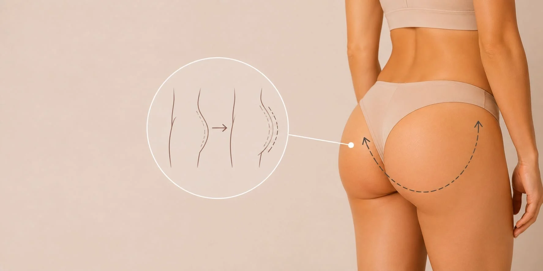 intervenciones-quirurgicas-gluteoplastia