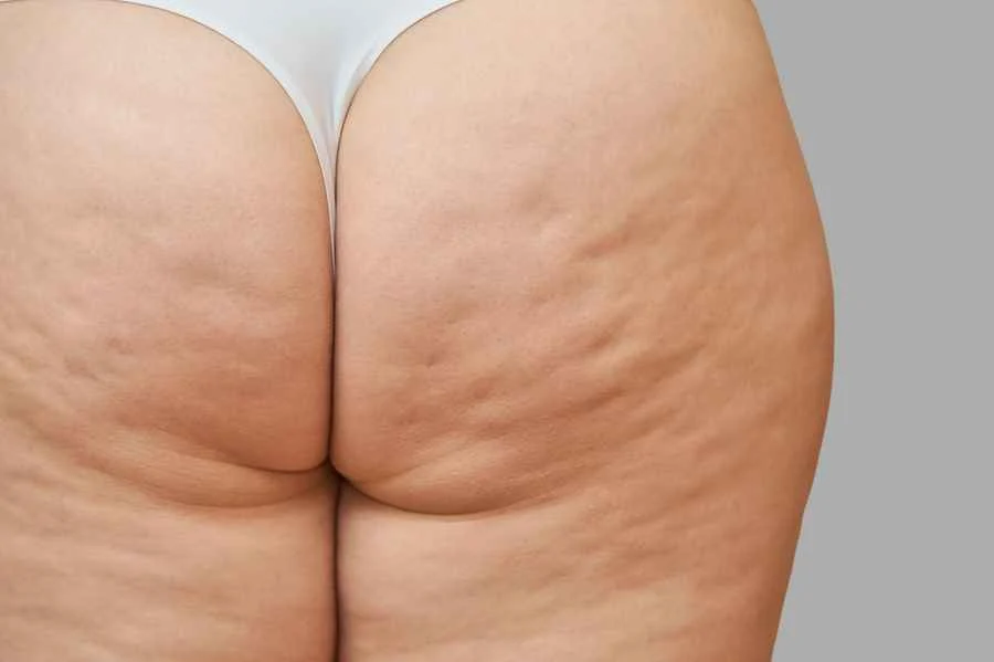 celulitis grado dos
