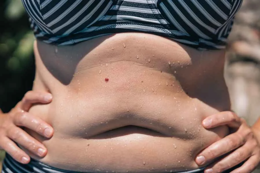 grasa en abdomen