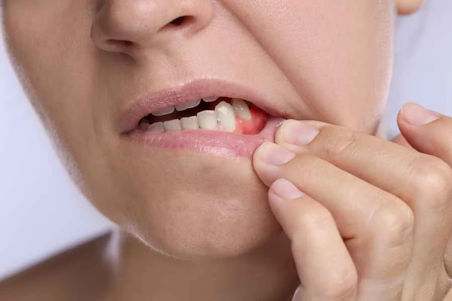 infección dental