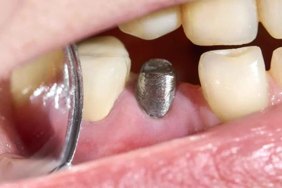pierda-pieza-dental